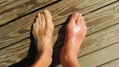 GOTA: QUÉ ES, SÍNTOMAS, CAUSAS Y TRATAMIENTO DE ESTA ENFERMEDAD INFLAMATORIA